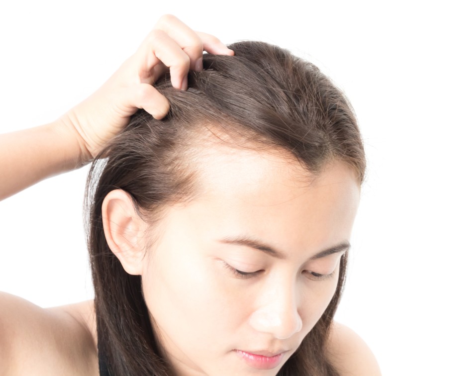 hair loss among women